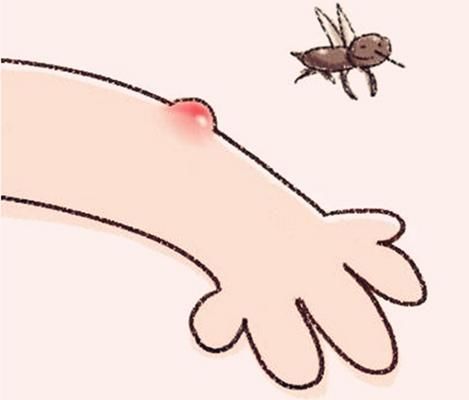 【哈尔滨肤康皮肤病医院科普】宝宝皮肤瘙痒能用哪些防蚊虫的办法！
